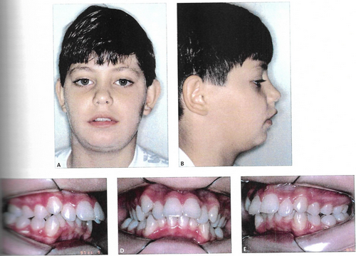 Criança com mdistoclusão, necessidade de aparelho ortodôntico