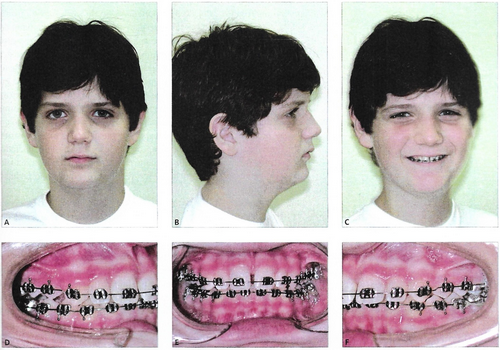 Criança com face curta, necessidade de aparelho ortodôntico