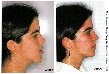 Ortognática classe III antes e depois